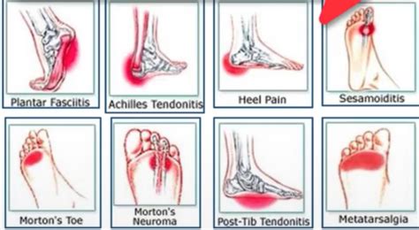 Areas of foot pain Foot Pain, Autoimmune, Health Fitness, Health And Beauty, Areas, Fitness, Leg ...