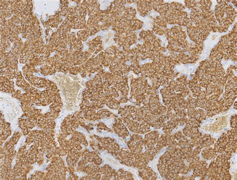 Pathology Outlines - Paraganglioma