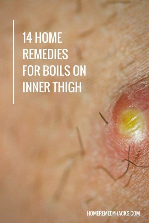 14 Proven Home Remedies for Boils on Inner Thigh | Home remedy for boils, Home remedies, Get rid ...