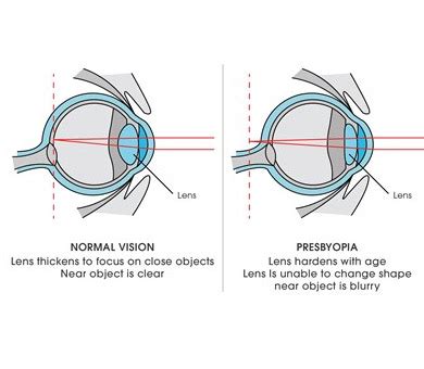 Delaware Eye Clinic| Presbyopia