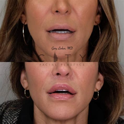 NYC Lip Lift Revision Surgery | UES Lip Lift Scar Repair | Cosmetic Surgery