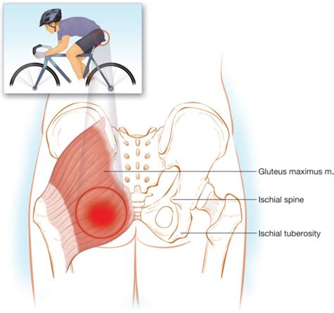 Ischial Bursitis