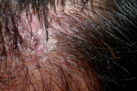 Folliculitis Decalvans: Pictures, Treatment, Management