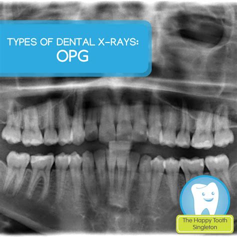 Types of dental x-rays – OPG | The Happy Tooth Singleton