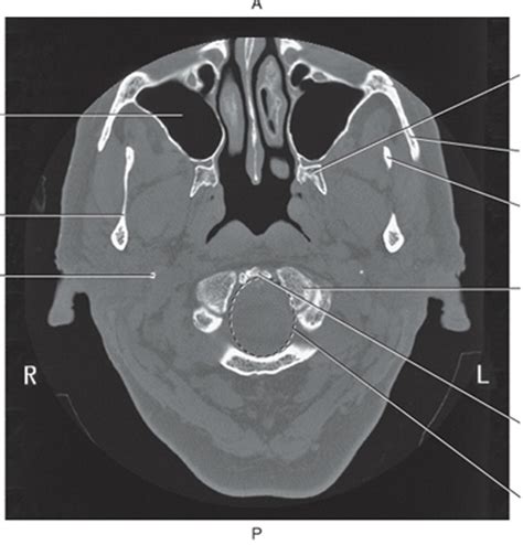 CT of Mandibular Rami Diagram | Quizlet