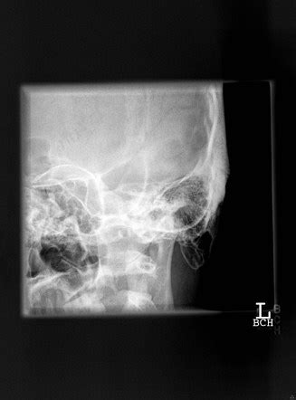 [最も人気のある！] laws view x ray mastoid 103877-How to do mastoid x ray - Jppngmuryoe0hls