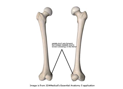 Miserable Malalignment Syndrome - Academy of Clinical Massage