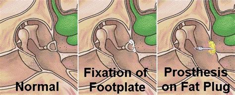 Stapedectomy - wikidoc