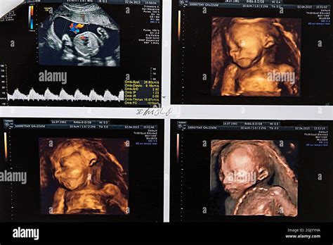 3D ultrasound of the 2nd trimester of a fetus Stock Photo - Alamy