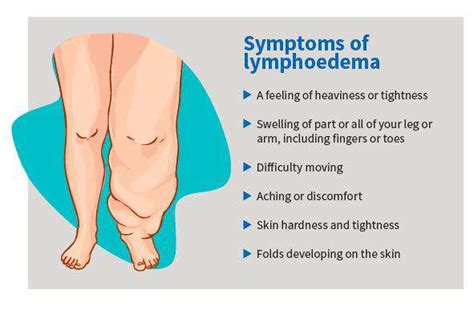 Exercises For Lymphoedema Of The Leg - Exercise Poster