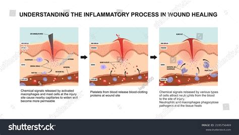 Understanding Inflammatory Process Wound Healing Stock Vector (Royalty ...