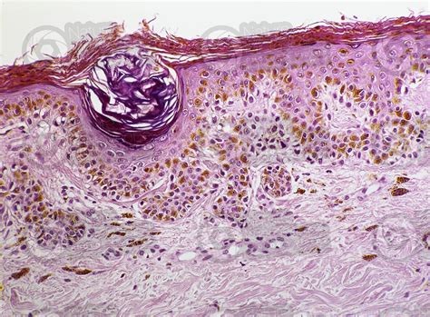 Man. Lentigo simplex. Lentigo. Vertical section. 125X - Nevus - Mammals ...