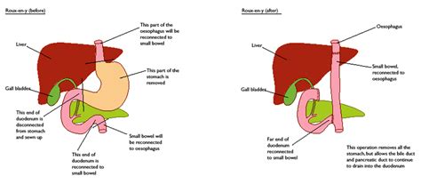 Gastrectomy - No Stomach For Cancer