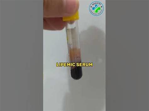 Lipemic serum | lipemic blood sample | Lipemia | causes of lipemia | hyperlipidemia - YouTube