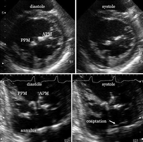 Immediate postoperative echocardiography. Short-axis view shows the... | Download Scientific Diagram