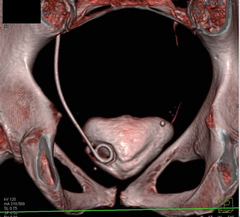 Left Ureteral Stent Within Distal Ureter and not in Bladder - Kidney ...