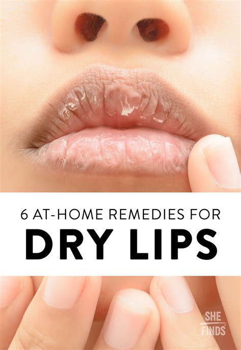 6 At-Home Remedies For Dry Lips | Dry lips remedy, Dry lips, Chapped ...