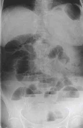 Sentinel Loop Sign In Pancreatitis : The presence of calcifications ...