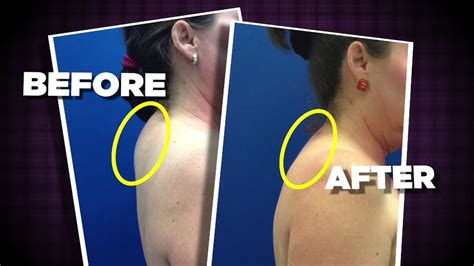 New procedure that gets rid of the "buffalo hump" | abc13.com