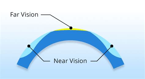 Laser Eye Surgery For Presbyopia - Find Health Tips