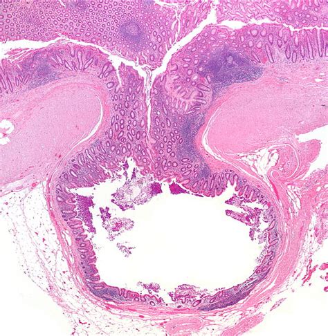 Diverticular disease - Libre Pathology