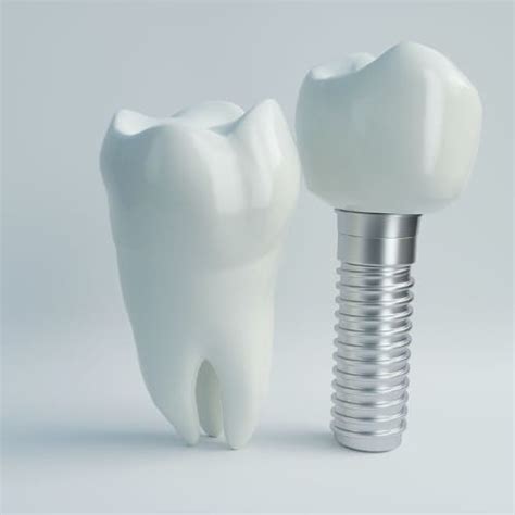 Implant dentaire Tunisie VIP | prix implantologie dentaire