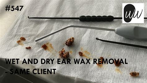 547 - Wet and Dry Ear Wax Removal From Same Client - YouTube