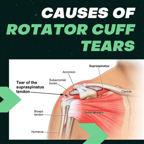 Causes of Rotator Cuff Tears | Ashvin K Dewan, MD