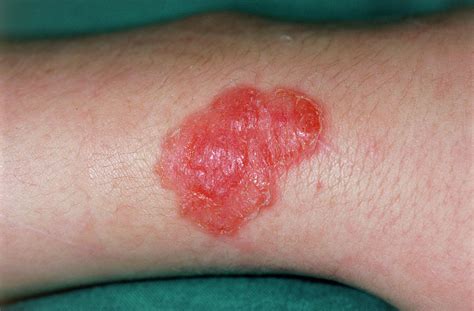 The Arm Of A Patient Affected By Impetigo Photograph by Dr P. Marazzi/science Photo Library