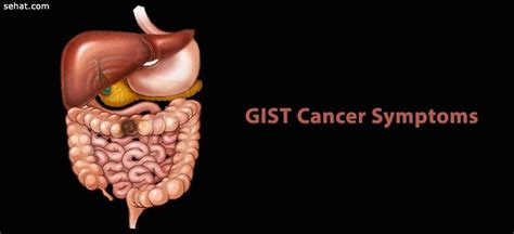 GIST Cancer Symptoms | What is GIST Cancer | Sehat