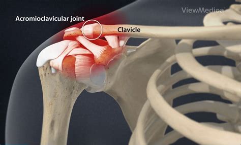 Arthrosis Of Acromioclavicular Joint - Image to u