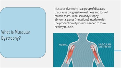 PPT - Stem Cell Muscular Dystrophy Treatment PowerPoint Presentation, free download - ID:10677817