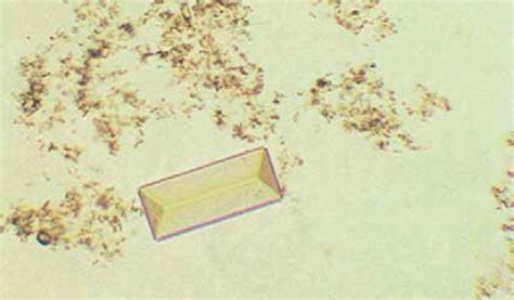 variation in Triple phosphate crystals | Medical Laboratories