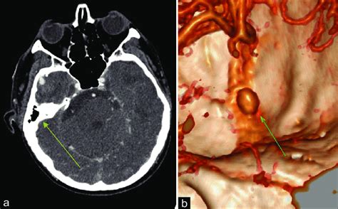 Aneurysm of the right middle meningeal artery in contact with the... | Download Scientific Diagram