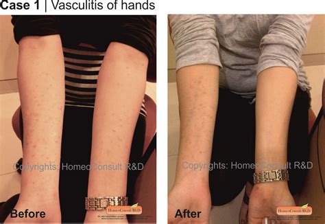 HomeoConsult RD: Vasculitis homeopathy treatment