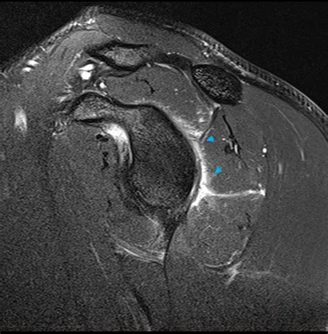 MRI Shoulder - Musculoskeletal Imaging