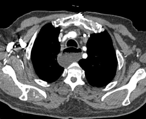 Achalasia - Esophagus Case Studies - CTisus CT Scanning
