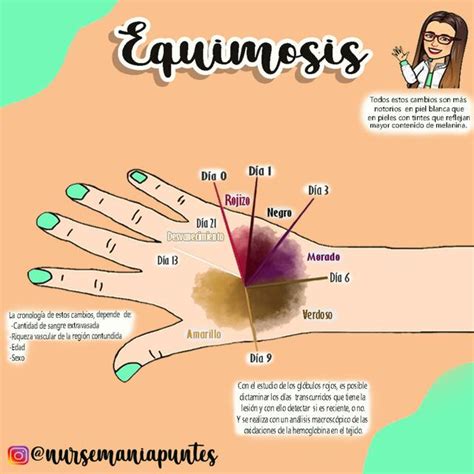 Equimosis | Nursemaniapuntes | uDocz