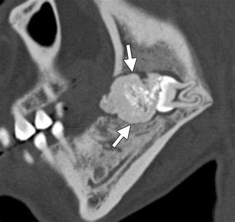 Radiopaque Jaw Lesions: An Approach to the Differential Diagnosis | RadioGraphics