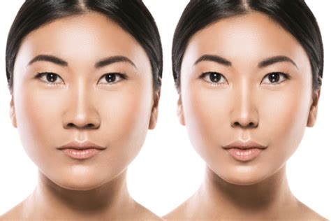 How is an Asian Rhinoplasty Performed? | Dr. Anthony Corrado