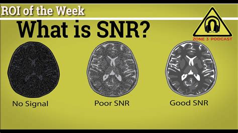 What is SNR? And Why is it so Important? One of MRI most important ...