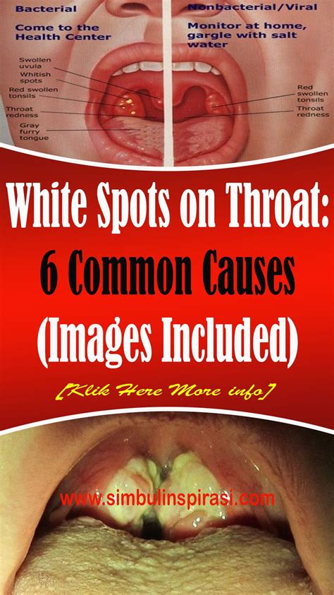 White spots on the throat are normally an indication of viral or bacterial contamination. On the ...