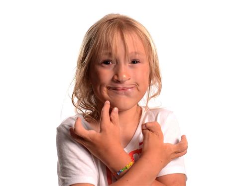 Girl EEC 72 2 | National Foundation for Ectodermal Dysplasias