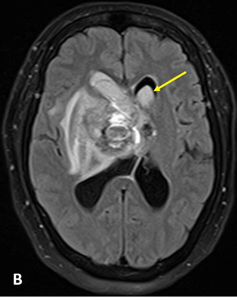 Intraventricular Hemorrhage (IVH) - MRI Online