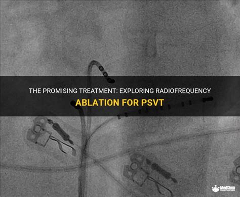 The Promising Treatment: Exploring Radiofrequency Ablation For Psvt | MedShun