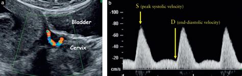 Siêu âm Doppler chỉ số PI của động mạch tử cung ở thai quý I ...