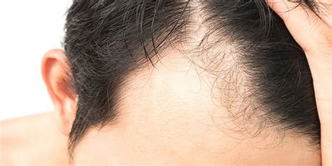 Alopecia Areata Hair Loss Treatment | Norris Dermatology Portland OR
