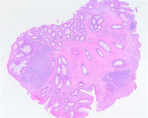 Hyperplastic Polyp Colon