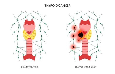 Premium Vector | Thyroid cancer stages