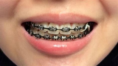 #braces #braces #aesthetic Kids Braces, Adult Braces, Braces Tips, Teeth Braces, Dental Braces ...